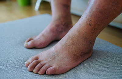 Diabetic Foot Care and Surgery